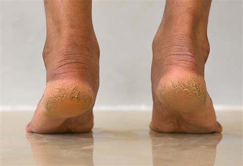 Dry Feet Cracked Heels — Medical Secrets