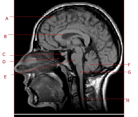 Sagittal View Of The Human Brain Labeled Sagittal Bra Vrogue Co