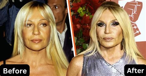 Donatella Versace Before Plastic Surgery The Shocking Truth About
