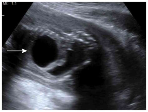 Misdiagnosis Of A Cloacal Exstrophy Variant As Urorectal Septum Malformation In A Fetus By