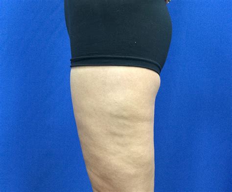 Beverly Hills Patient Gets Smaller Thighs With Thigh Lift Surgery