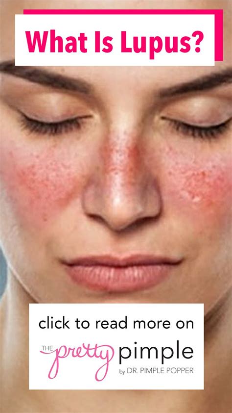 What Is Lupus And How Does It Affect The Body Rash On Face Skin