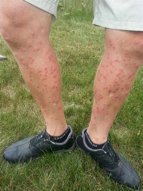 Swimmers Itch Researchers Pinpoint Weather Conditions That Bring The
