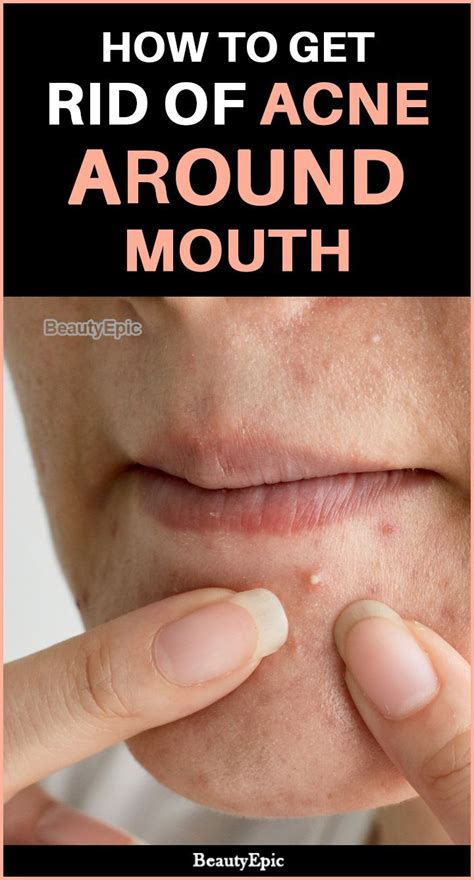 How To Get Rid Of Acne Around Mouth Poppingpimples Chin Acne Chin