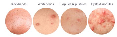 Types Of Acne Scars You Should Know M Aesthetic