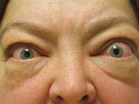 Graves Disease Causes Signs Symptoms Medication Treatment