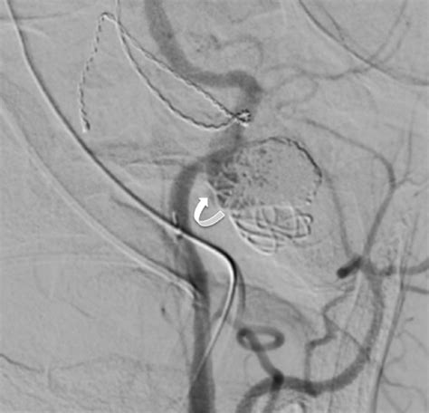 Angiogram Left Common Carotid Artery Injection Anteroposterior View
