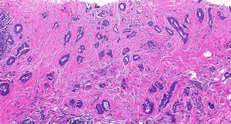 Pathology Outlines Invasive Breast Cancer Of No Special Type Nst