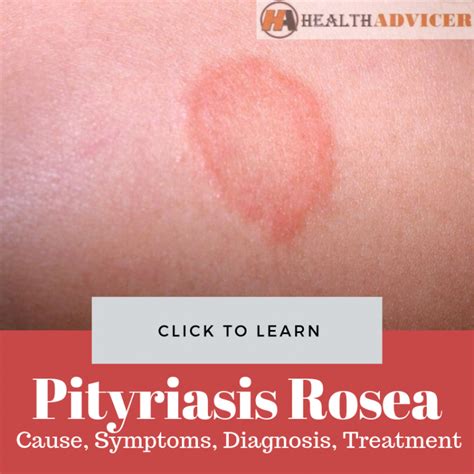 What Causes Pityriasis Rosea Rash