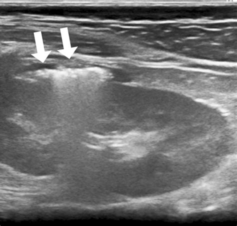 Longitudinal Ultrasound Of The Left Kidney In A Year Old Girl With Download Scientific