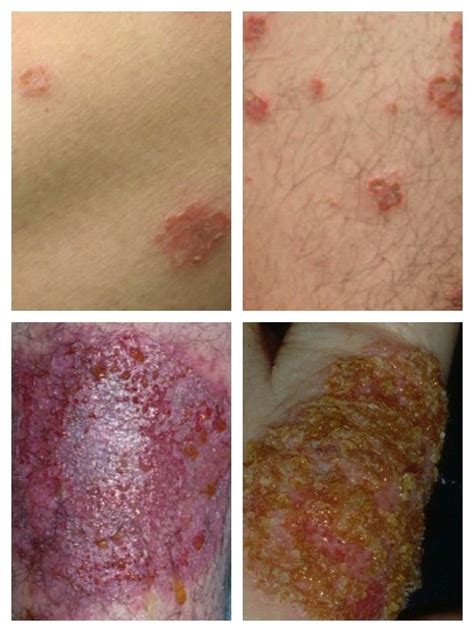 2018 Skin Rashes Guide Filled With Pictures And Treatment Tips