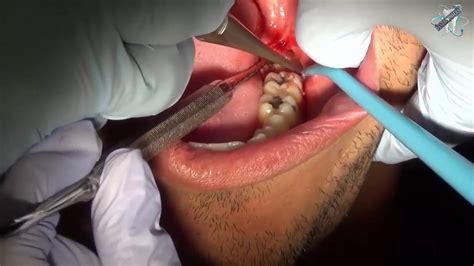 I recently had 2 wisdom teeth out. how to pull wisdom tooth..خلع السن المدفون - YouTube