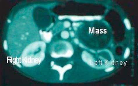 Abdominal Ct Showing The Left Kidney And The Over Lying Mass
