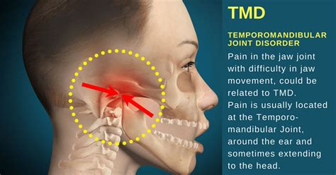 Tmd Causes Symptoms And Effective Physical Therapy Treatment Blue