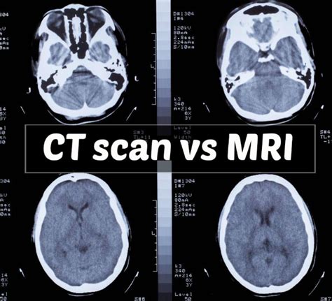 Difference Between A Ct Scan And A Cat Scan Catwalls