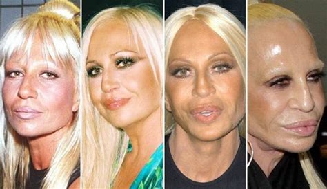 Donatella Versace Plastic Surgery Transformations Celebrity Plastic Surgery Online