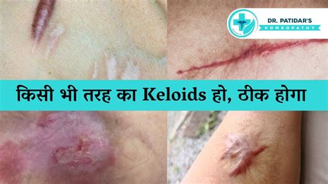 Keloids Homeopathic Treatment Causes And Homeopathic Medicines Dr