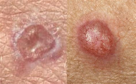 Main Type Of Skin Cancer Their Differences Histology And Prevention Andr As Astier