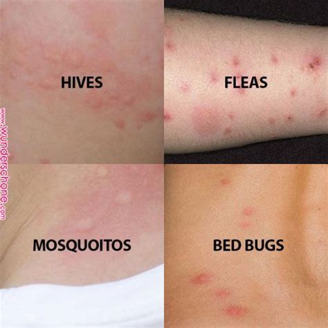 Can Bed Bug Bites Look Like Hives Kwhatdo