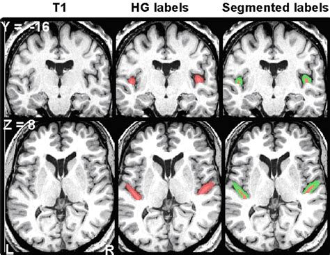 Relating Structure To Function Heschls Gyrus And Acoustic Processing Journal Of Neuroscience