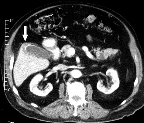 Adenomyomatosis Of The Gallbladder Another Cause For A “hot