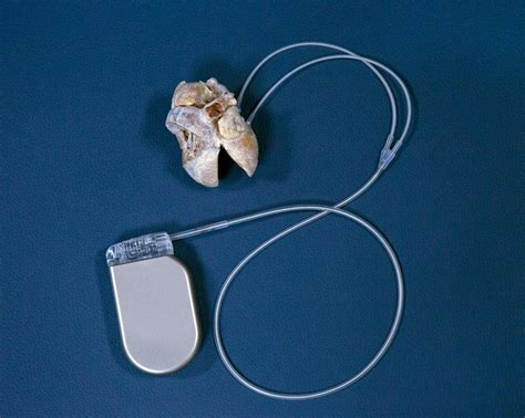 Implantable Cardioverter Defibrillator Scar