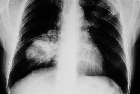 Lung Cancer Clinical Review Gponline