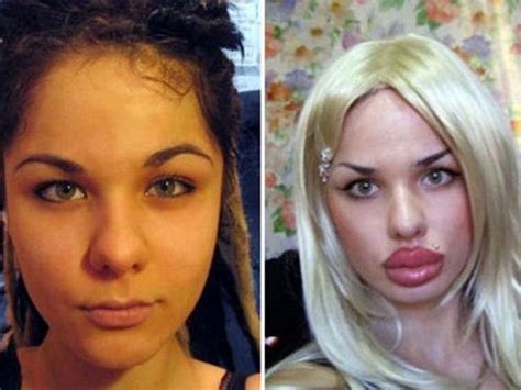 The Worst Plastic Surgery Disasters Of All Time Barnorama