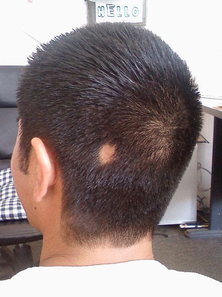 Alopecia Areata Causes Types Symptoms And Treatment Skinpractice