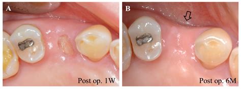 Pictures Of Granulation Tissue After Tooth Extraction F