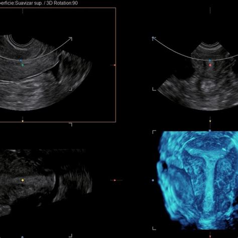 Uterine Cavity Measurement Protocol Applied In A T Shaped Uterus A Download Scientific