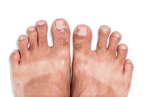 peeling feet causes symptoms home remedies pictures
