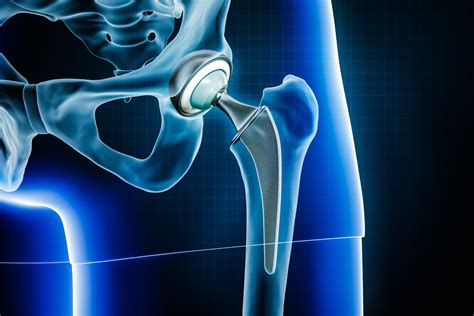Hip Replacement Surgery And Its Types Blog Meril Life