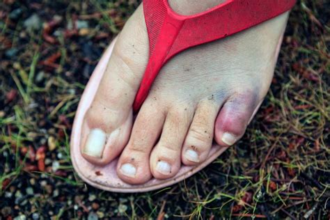 Check spelling or type a new query. Broken toe: Symptoms, pictures, and treatment