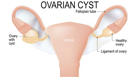 4 Signs Of Ovarian Cysts Womens Medical Nashville