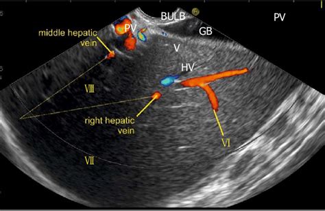 This Image From Duodenal Bulb Shows The Right And Middle Hepatic Vein