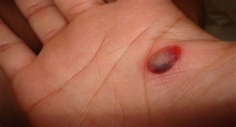 5 Effective Home Remedies To Get Rid Of Blood Blisters