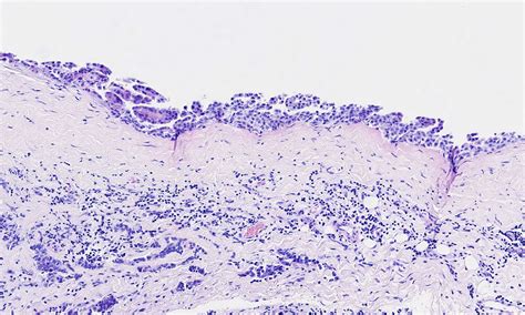 Pathology Outlines Mesothelioma Epithelioid