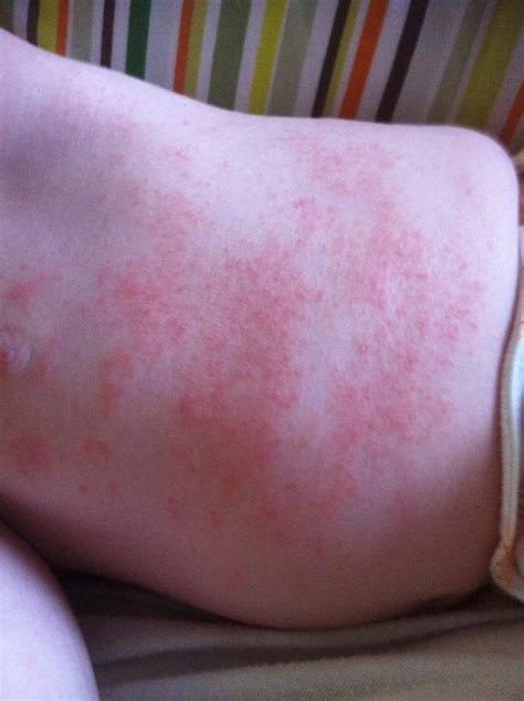 At first glance, it can be difficult to tell if itchy skin bumps are from bug bites or caused by an allergic reaction. Pin by Ashley (Petrus) Smith on Special needs info | Pinterest