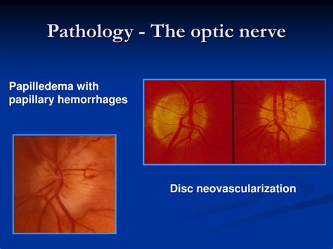 Ppt Direct Ophthalmoscopy Powerpoint Presentation Free Download Id