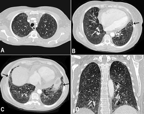 Chest Ct Pulmonary Window — Fibroemphysema A Centrilobular And