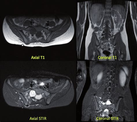 These Mri Scans Show A Year Old Female With Right Sacroiliac Joint My XXX Hot Girl