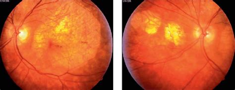 Fundus Examination Shows Large Sharply Demarcated Fields Of Choroidal