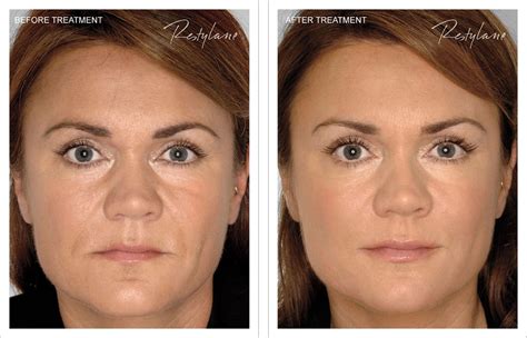 Before And After Restylane Filler Treatment A Photo On Flickriver