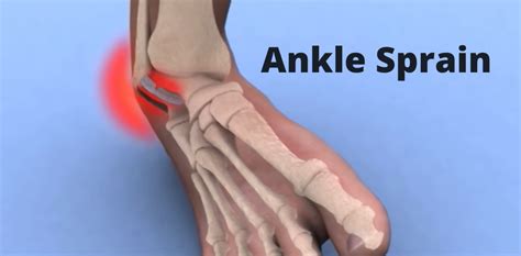 Ankle Sprain Symptoms 3 Grade Classification And Treatment Welcome