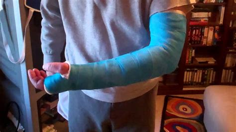New Blue Long Arm Cast Lac Youtube