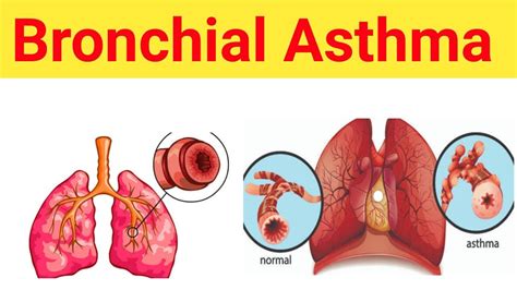 Bronchial Asthma Part Pharmacology Introduction Causes Factors