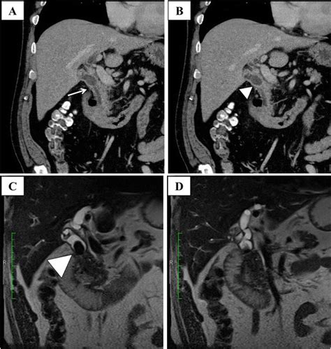 preoperative diagnosis on mdct and mrcp preoperative mdct revealed download scientific diagram