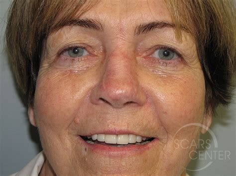 Nose Reconstruction 6 Skin Cancer And Reconstructive Surgery Center