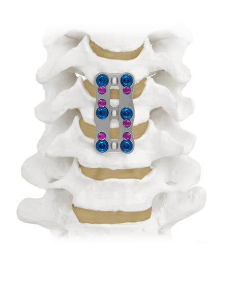 Xtend® Anterior Cervical Plate System グローバスメディカル